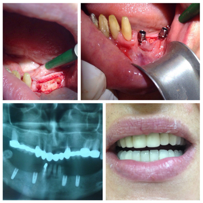 Dental implant procedure and result