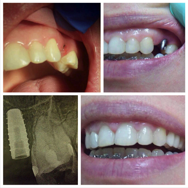 Dental implant case
