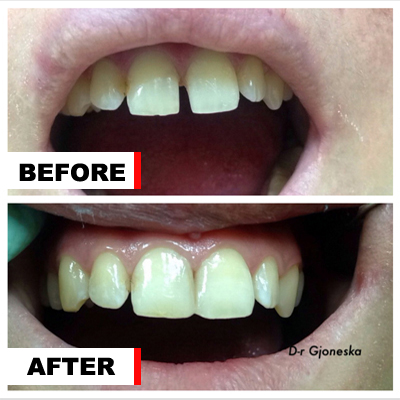 Dental pathology before and after