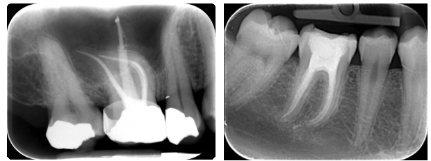 Endodontic treatment X-rays