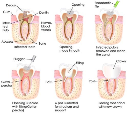 Endodontic treatment procedure