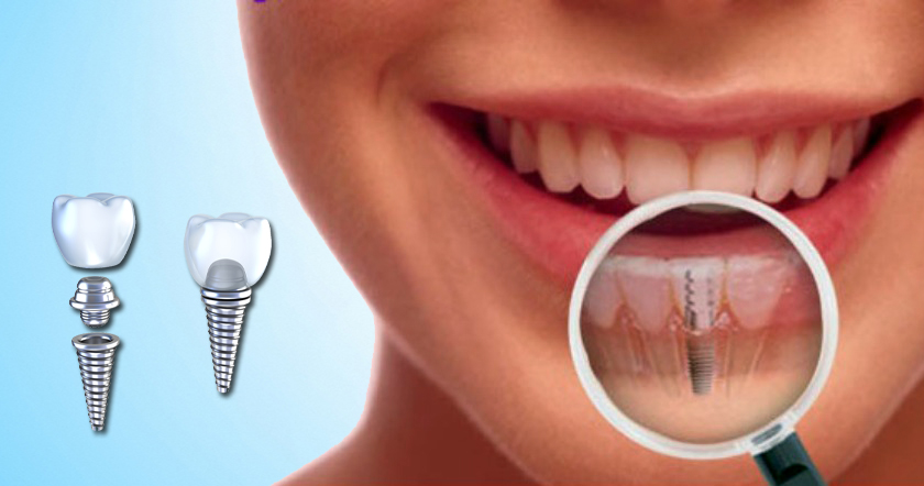 Dental implants