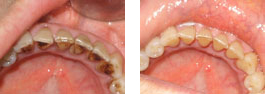 Before and after dental tartar cleaning