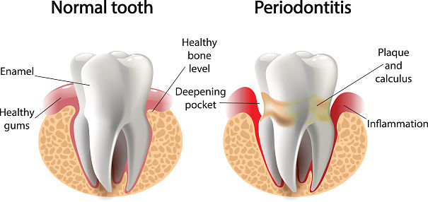 Normal tooth and periodontitis