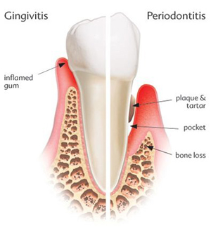Gingivitis and periodontitis