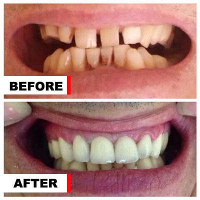 Before and after dental bridges case two