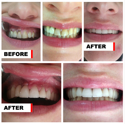 Before and after zirconia crowns and bridges